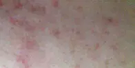 红色痘印